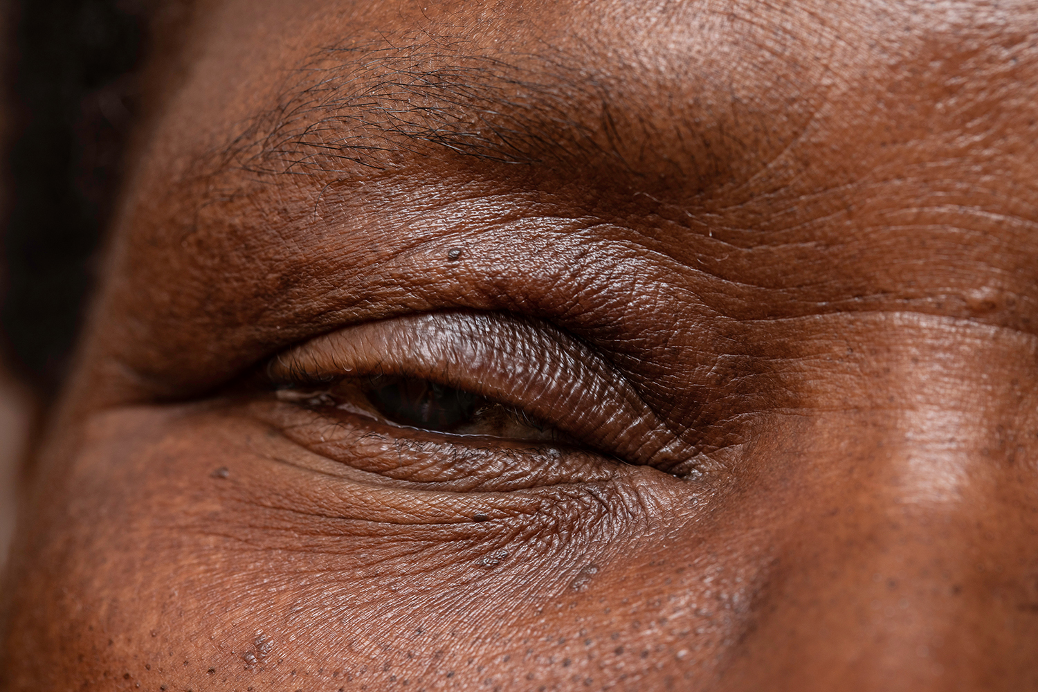 Woman,With,Drooping,Eyelid,,Symptoms,Of,Congenital,Palpebular,Ptosis